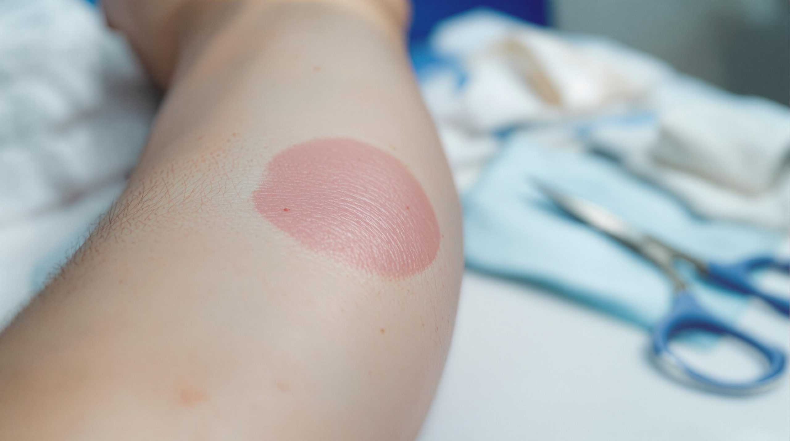 Cicatrice boursouflée après opération : comprendre et traiter efficacement - Vie Harmonieuse